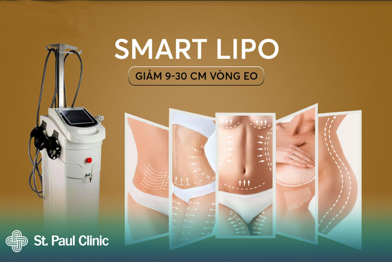 Công nghệ giảm béo Smart Lipo đã được khá nhiều chi em phụ nữ tin dùng và kiểm chứng chất lượng