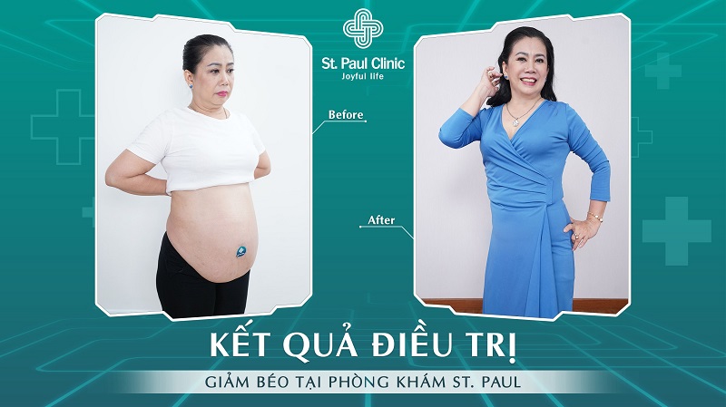 Hình ảnh sau giảm béo tại ST Paul của cô Thanh Ngọc
