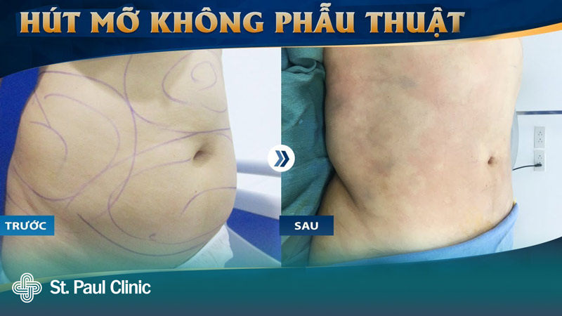 Công nghệ giảm mỡ bụng không phẫu thuật Vaser 4D tại Kangnam