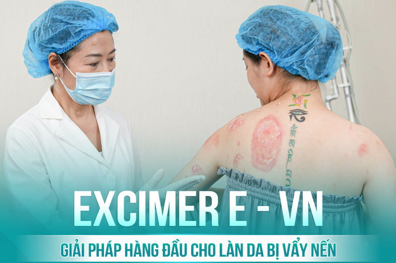 Excimer E-VN - Phương pháp trị vẩy nến bằng công nghệ cao độc quyền tại St.Paul